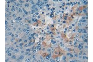 Detection of CEA in Human Liver cancer Tissue using Polyclonal Antibody to Carcinoembryonic Antigen (CEA) (CEA 抗体  (AA 448-572))