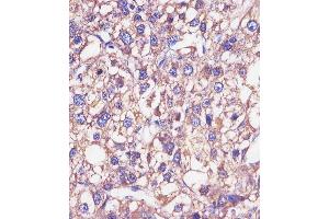 (ABIN652875 and ABIN2842566) staining HP in human epatocarcinoma sections by Immunohistochemistry (IHC-P - paraformaldehyde-fixed, paraffin-embedded sections). (Haptoglobin 抗体  (Center))