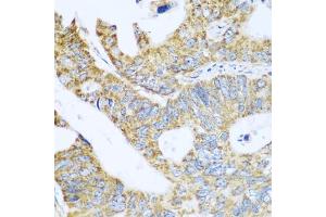 Immunohistochemistry of paraffin-embedded human colon carcinoma using GLUD1 antibody (ABIN5975614) at dilution of 1/100 (40x lens). (GLUD1 抗体)