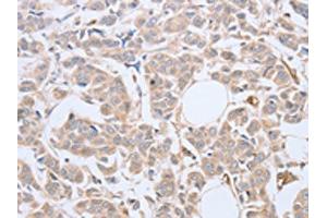 The image on the left is immunohistochemistry of paraffin-embedded Human breast cancer tissue using ABIN7128138(ABHD5 Antibody) at dilution 1/10, on the right is treated with fusion protein. (ABHD5 抗体)
