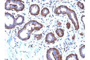 Formalin-fixed, paraffin-embedded human Breast Carcinoma stained with Ferritin LC Rabbit Recombinant Monoclonal Antibody (FTL/2338R). (Recombinant FTL 抗体  (AA 38-165))