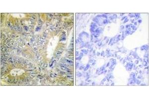 Immunohistochemistry analysis of paraffin-embedded human colon carcinoma tissue, using Desmin (Ab-60) Antibody.