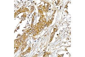 Immunohistochemistry of paraffin-embedded human breast cancer using UQCRH Rabbit mAb (ABIN7271126) at dilution of 1:50 (40x lens). (UQCRH 抗体)