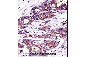 N Antibody (C-term) ((ABIN389343 and ABIN2839452))immunohistochemistry analysis in formalin fixed and paraffin embedded human colon carcinoma followed by peroxidase conjugation of the secondary antibody and DAB staining. (NPM1 抗体  (C-Term))