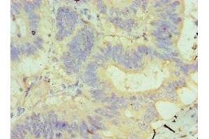 Immunohistochemistry of paraffin-embedded human colon cancer using ABIN7145506 at dilution of 1:100 (Glucuronidase beta 抗体  (AA 382-651))