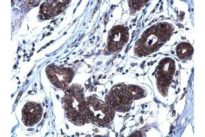 IHC-P Image RANKL antibody [C2C3], C-term detects RANKL protein at membrane on human breast carcinoma by immunohistochemical analysis. (RANKL 抗体  (C-Term))