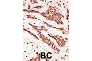 Formalin-fixed and paraffin-embedded human cancer tissue reacted with the primary antibody, which was peroxidase-conjugated to the secondary antibody, followed by AEC staining. (EDG4 抗体  (N-Term))