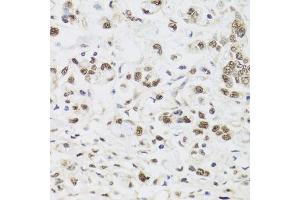 Immunohistochemistry of paraffin-embedded human gastric cancer using PPP1CC antibody. (PPP1CC 抗体)