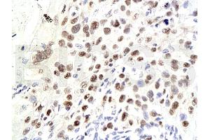 Formalin-fixed and paraffin embedded human laryngeal squamous cell carcinoma labeled Anti-P21/CDKN1A Polyclonal Antibody, Unconjugated (ABIN672606) at 1:200, followed by conjugation to the secondary antibody and DAB staining (p21 抗体  (AA 101-164))