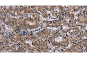 Immunohistochemistry of paraffin-embedded Human thyroid cancer using P2RX2 Polyclonal Antibody at dilution of 1:50 (P2RX2 抗体)