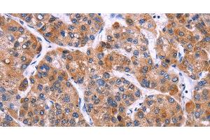 Immunohistochemistry of paraffin-embedded Human liver cancer tissue using MSMO1 Polyclonal Antibody at dilution 1:40 (SC4MOL 抗体)