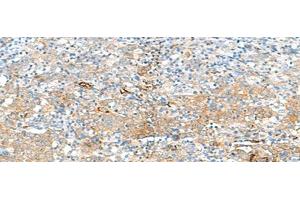 Immunohistochemistry of paraffin-embedded Human cervical cancer tissue using HLA-DRB3 Polyclonal Antibody at dilution of 1:50(x200) (HLA-DRB3 抗体)