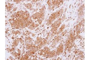 IHC-P Image Immunohistochemical analysis of paraffin-embedded human breast cancer, using RGS10, antibody at 1:250 dilution. (RGS10 抗体)