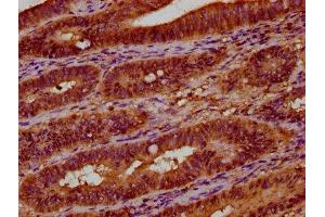 IHC image of ABIN7174645 diluted at 1:300 and staining in paraffin-embedded human colon cancer performed on a Leica BondTM system. (UGT2B7 抗体  (AA 237-382))