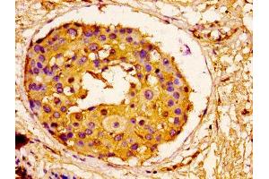 IHC image of ABIN7143742 diluted at 1:100 and staining in paraffin-embedded human breast cancer performed on a Leica BondTM system. (ORM1 抗体  (AA 19-201))