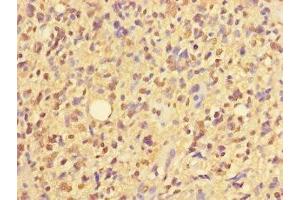 Immunohistochemistry of paraffin-embedded human glioma using ABIN7176377 at dilution of 1:100 (ZNF559 抗体  (AA 1-300))