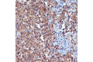 Immunohistochemistry of paraffin-embedded human thyroid cancer using PKC delta Rabbit mAb  at dilution of 1:100 (40x lens). (PKC delta 抗体)