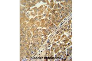 CR025 antibody immunohistochemistry analysis in formalin fixed and paraffin embedded human bladder carcinoma followed by peroxidase conjugation of the secondary antibody and DAB staining. (C18ORF25 抗体  (AA 163-191))