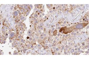 ABIN6274010 at 1/100 staining Human Melanoma tissue by IHC-P. (HAPLN1 抗体  (N-Term))