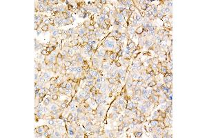 Immunohistochemistry of paraffin-embedded human liver cancer using Annexin  Rabbit pAb  at dilution of 1:25 (40x lens). (Annexin A2 抗体)
