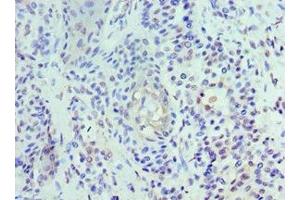 Immunohistochemistry of paraffin-embedded human breast cancer using ABIN7174459 at dilution of 1:100 (UBE2J2 抗体  (AA 1-230))