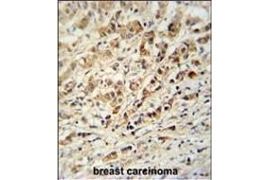 AVL9 Antibody (C-term) (ABIN651037 and ABIN2840044) immunohistochemistry analysis in formalin fixed and paraffin embedded human breast carcinoma followed by peroxidase conjugation of the secondary antibody and DAB staining. (AVL9 抗体  (C-Term))