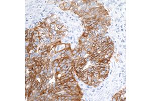 Immunohistochemistry (IHC) image for anti-Epithelial Cell Adhesion Molecule (EPCAM) (AA 264-314) antibody (ABIN7455204) (Recombinant EpCAM 抗体  (AA 264-314))