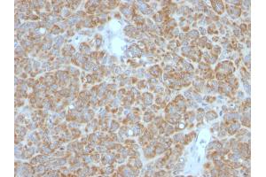 Formalin-fixed, paraffin-embedded human Melanoma stained with Bcl-2 Monoclonal Antibody (BCL2/782 + BCL2/796).