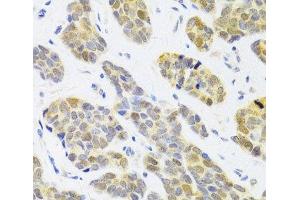 Immunohistochemistry of paraffin-embedded Human breast cancer using RFC4 Polyclonal Antibody at dilution of 1:100 (40x lens). (RFC4 抗体)