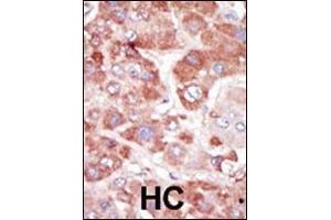 Formalin-fixed and paraffin-embedded human cancer tissue reacted with the primary antibody, which was peroxidase-conjugated to the secondary antibody, followed by AEC staining. (GRK7 抗体  (C-Term))
