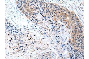 The image on the left is immunohistochemistry of paraffin-embedded Human esophagus cancer tissue using ABIN7190229(CFC1 Antibody) at dilution 1/20, on the right is treated with synthetic peptide. (CFC1 抗体)
