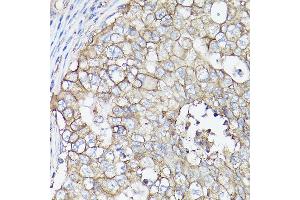 Immunohistochemistry of paraffin-embedded human breast cancer using MCT4/SLC16 Rabbit pAb (ABIN6129472, ABIN6147859, ABIN6147860 and ABIN6214836) at dilution of 1:100 (40x lens). (SLC16A3 抗体  (AA 371-465))