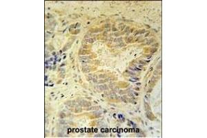 FB Antibody (Center) (ABIN651921 and ABIN2840456) immunohistochemistry analysis in formalin fixed and paraffin embedded human prostate carcinoma followed by peroxidase conjugation of the secondary antibody and DAB staining. (FAM105B 抗体  (AA 99-128))