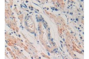 DAB staining on IHC-P; Samples: Human Stomach cancer Tissue (IGLL1 抗体  (AA 29-201))