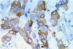 Immunohistochemistry (IHC) analyzes of p-IGF1R antibody in paraffin-embedded human lung adenocarcinoma tissue. (IGF1R 抗体  (pTyr980))