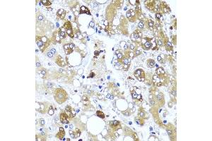 Immunohistochemistry of paraffin-embedded human liver damage using IL4 antibody (ABIN6128137, ABIN6142396, ABIN6142397 and ABIN6221290) at dilution of 1:100 (40x lens). (IL-4 抗体  (AA 25-153))