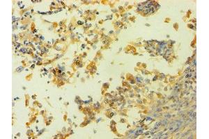 Immunohistochemistry of paraffin-embedded human cervical cancer using ABIN7155116 at dilution of 1:100 (HNRNPH1 抗体  (AA 2-449))