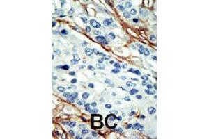 Formalin-fixed and paraffin-embedded human cancer tissue reacted with NUAK1 polyclonal antibody  , which was peroxidase-conjugated to the secondary antibody, followed by DAB staining. (NUAK1 抗体  (C-Term))