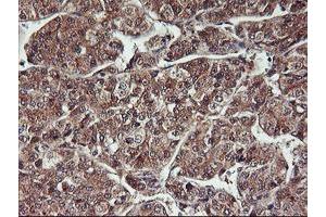 Immunohistochemical staining of paraffin-embedded Carcinoma of Human liver tissue using anti-HDHD1 mouse monoclonal antibody. (HDHD1 抗体)