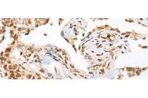 Immunohistochemistry of paraffin-embedded Human ovarian cancer tissue using ATN1 Polyclonal Antibody at dilution of 1:50(x200) (Atrophin 1 抗体)