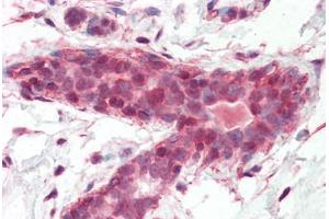Human Breast (formalin-fixed, paraffin-embedded) stained with BRAP antibody ABIN462090 followed by biotinylated goat anti-rabbit IgG secondary antibody ABIN481713, alkaline phosphatase-streptavidin and chromogen. (BRAP 抗体  (AA 67-79))