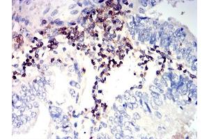 Immunohistochemical analysis of paraffin-embedded endometrial cancer tissues using CD352 mouse mAb with DAB staining. (SLAMF6 抗体  (AA 22-226))