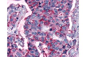 Anti-FZD5 / Frizzled 5 antibody IHC of human Lung, Non-Small Cell Carcinoma. (FZD5 抗体  (Cytoplasmic Domain))