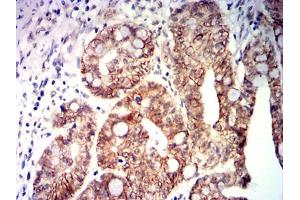 Immunohistochemical analysis of paraffin-embedded rectal cancer tissues using CDX2 mouse mAb with DAB staining. (CDX2 抗体  (AA 1-180))