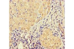 Immunohistochemistry of paraffin-embedded human liver cancer using ABIN7158316 at dilution of 1:100 (LHFPL1 抗体  (AA 21-85))