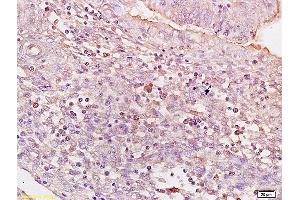 Formalin-fixed and paraffin embedded human colon carcinoma tissue labeled with Anti BACH1/BRIP1 Polyclonal Antibody,Unconjugated (ABIN753718) at 1:200 followed by conjugation to the secondary antibody and DAB staining. (BRIP1 抗体)