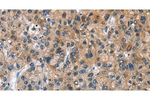 Immunohistochemistry of paraffin-embedded Human liver cancer tissue using BPI Polyclonal Antibody at dilution 1:50 (BPI 抗体)