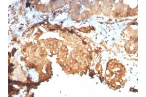 Formalin-fixed, paraffin-embedded human Breast Carcinoma stained with GRP94 Recombinant Rabbit Monoclonal Antibody (HSP90B1/3168R). (Recombinant GRP94 抗体)