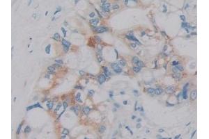 Detection of IL2 in Human Bile duct cancer Tissue using Monoclonal Antibody to Interleukin 2 (IL2) (IL-2 抗体  (AA 21-153))
