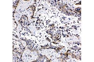 IHC-P: MRP1 antibody testing of human lung cancer tissue (MRP1 抗体)